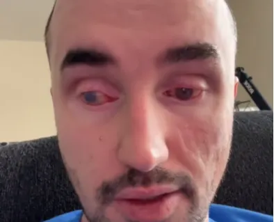 Help Noah Afford Scleral Lenses and Eye Surgery